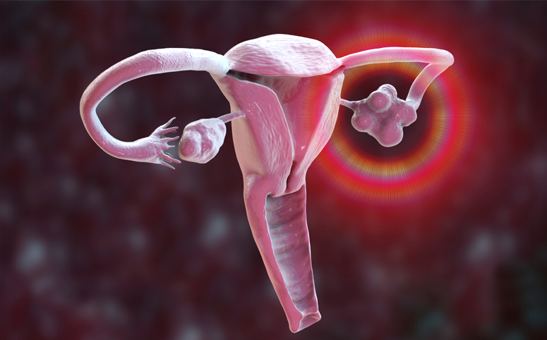 Why Early Diagnosis and Treatment of PCOS Matters