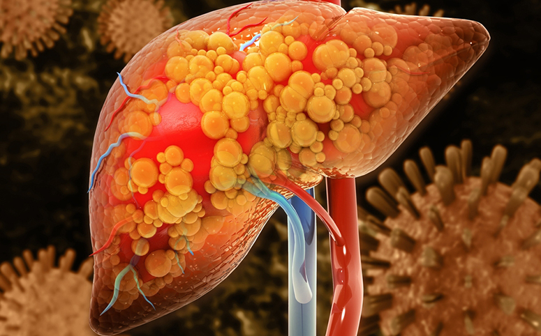 What Is Fatty Liver Disease? Understanding, MASLD and MASH
